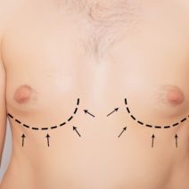 A man's chest with incision marks and arrows for breast augmentation