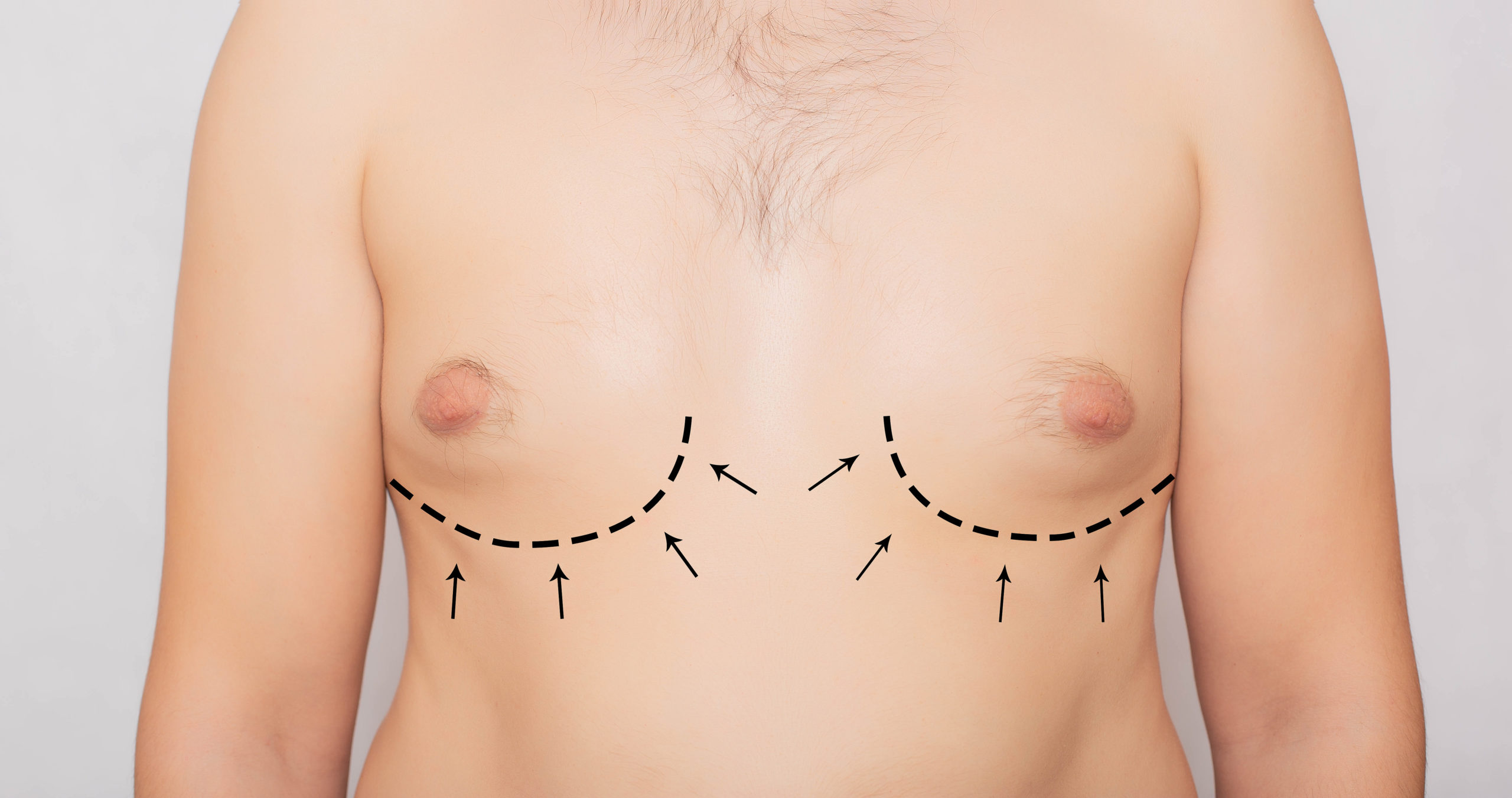 A man's chest with incision marks and arrows for breast augmentation