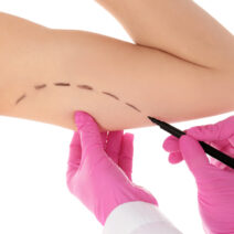Doctor drawing marks on woman's arm against white background. Cosmetic surgery. Arm Lift Toronto.